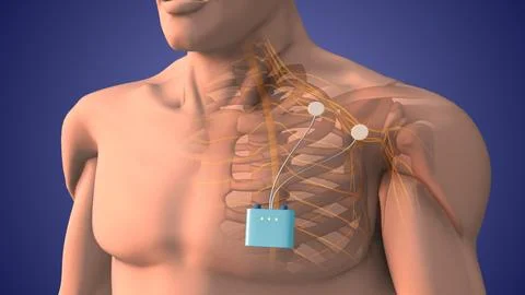 Peripheral nerve stimulation therapy in shoulder area Stock Illustration