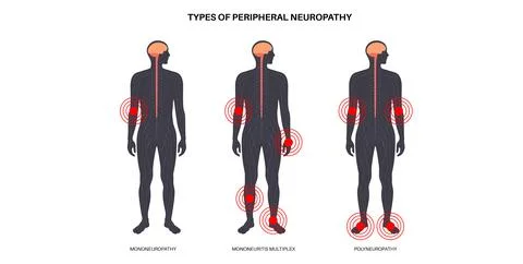 Peripheral neuropathy medical poster Illustrazione stock