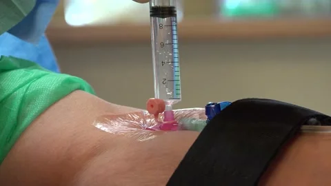 Peripheral Venous Catheter being installed Stock Footage 239684605