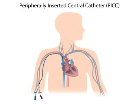Peripherally inserted central catheter Stock Illustration