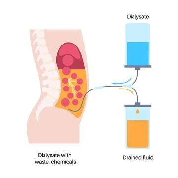 Peritoneal dialysis concept Stock Illustration