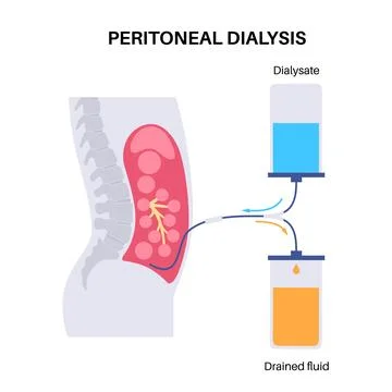 Peritoneal dialysis concept Stock Illustration