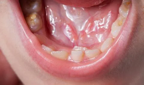 A permanent molar in a child grows second row. Incorrect growth of molars or Stockfoto's