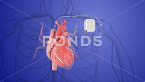 Permanent pacemaker implant medical concept ~ Clip Art #247065227