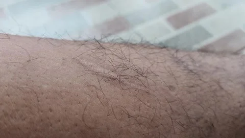 Permanent Scar on Calf Leg Close Up Human Skin Detail Stock Footage 328383320