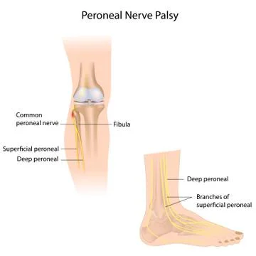 Peroneal nerve palsy Stock Illustration