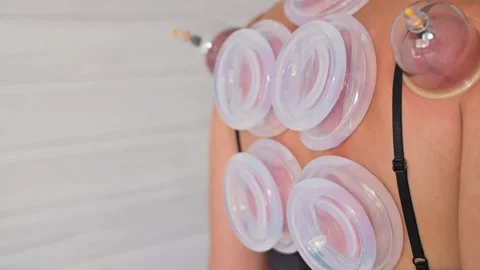 A person applies cups on the upper back, using cupping therapy for muscle Vidéo 344379411