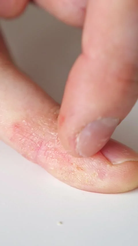 Person with atopic dermatitis scratching an itchy, dry, and cracked finger with Stock Footage 344798908