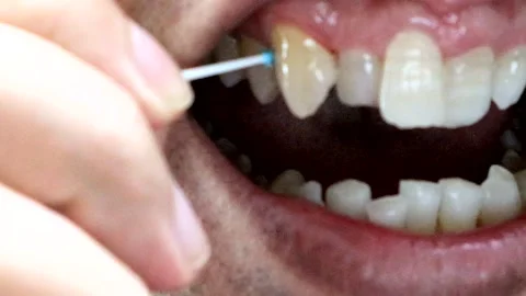 A person cleaning the gaps between their teeth with an interdental brush. Stock Footage 335607194