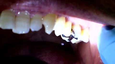 Person examining teeth Stock Footage 327885642