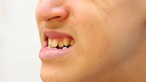 A person to have a bad bite Stock Footage 87289755