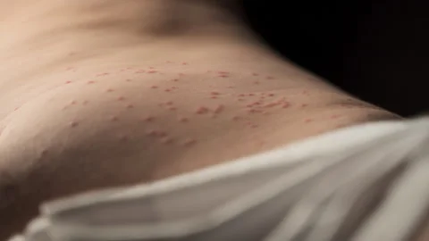 A person lying down has been bitten on the stomach, with the abdominal Stock Footage 244697950