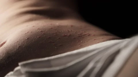 The person lying down has suffered bites on the stomach, resulting in the Video stock 244697922