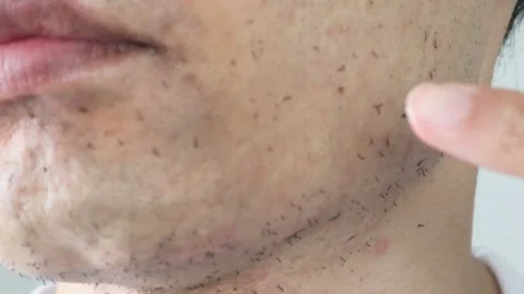 A person pointing at a beard removed by laser hair removal Stock Footage 326088624