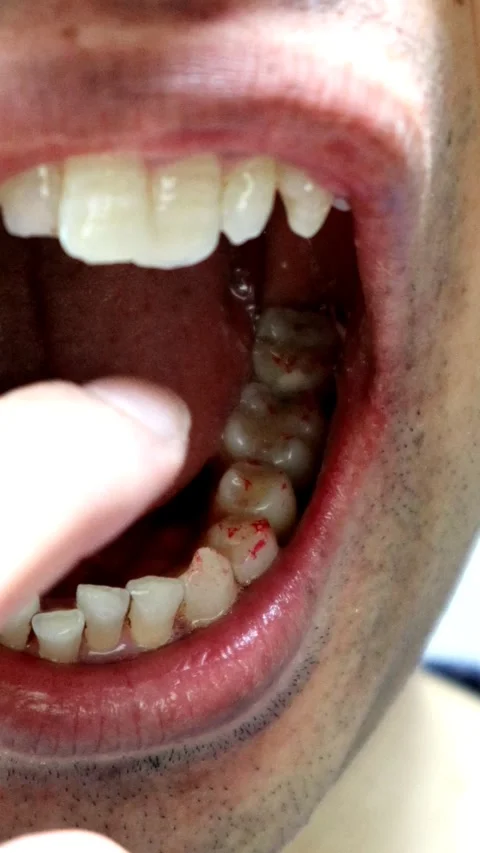 A person pointing to a tooth after a cavity has been treated. Stock Footage 335947483