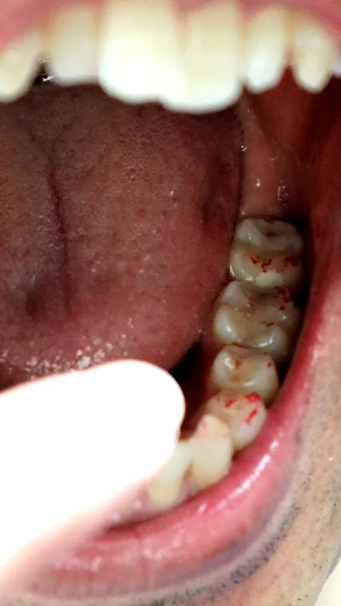 A person pointing to a tooth after a cavity has been treated. Stock-Footage 335952234