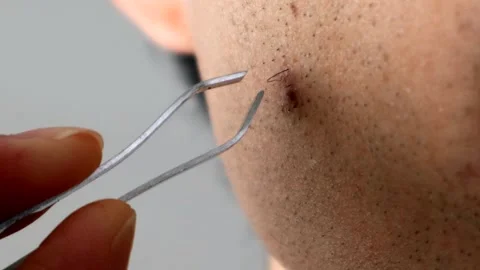 A person pulling an ingrown beard hair Stock Footage 326089337