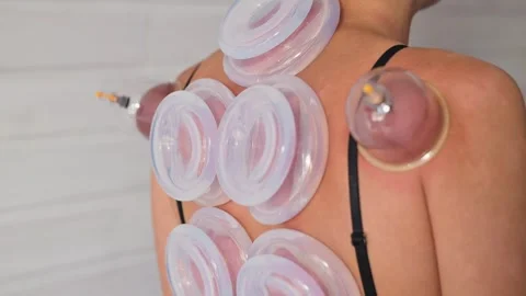 A person receives cupping therapy using vacuum cups on their back in a clean Видео 344379417