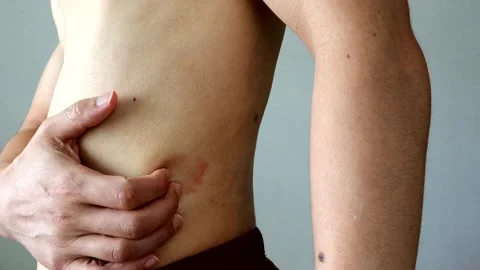 Person scratching eczema Stock Footage 329335316