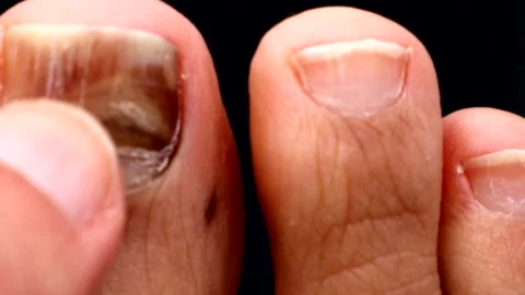A person touching their fingernails, which have become discolored due to injury. Stock Footage 335253547