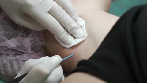 A person wearing white gloves performs medical procedures such as removing .. Stock Footage 331251922
