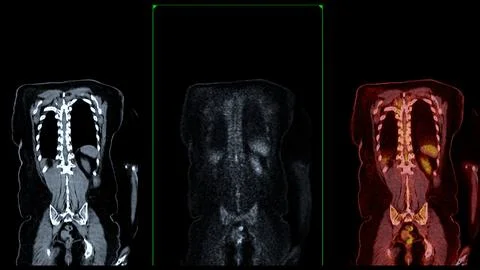 PET CT Scan fusion image It provides detailed images by merging metabolic act Stock Illustration