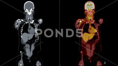 PET CT Scan fusion image It provides detailed images by merging ...