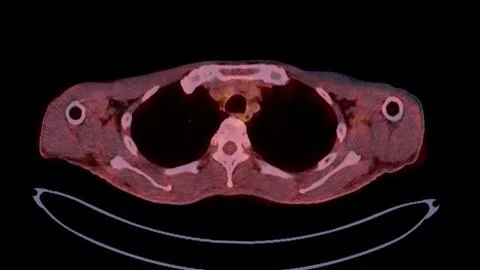 A PET-CT scan image is a diagnostic visualization combining Positron Emissi.. Stock Illustration