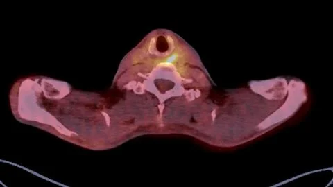 A PET-CT scan image is a diagnostic visualization combining Positron Emissi.. Stock Illustration