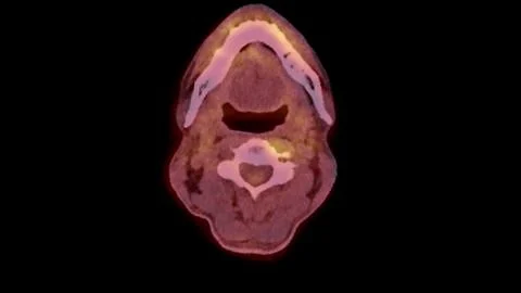 A PET-CT scan image is a diagnostic visualization combining Positron Emissi.. Stock Illustration