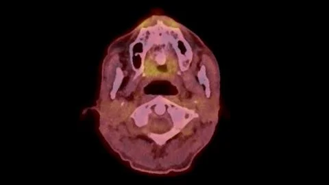 A PET-CT scan image is a diagnostic visualization combining Positron Emissi.. Stock Illustration