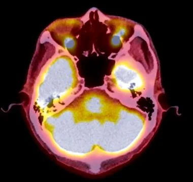 A PET-CT scan image is a diagnostic visualization combining Positron Emissi.. Stock Illustration