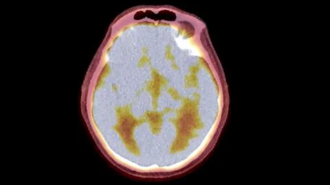 A PET-CT scan image is a diagnostic visualization combining Positron Emissi.. Stock Illustration