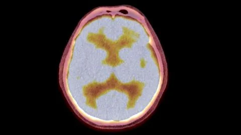 A PET-CT scan image is a diagnostic visualization combining Positron Emissi.. Stock Illustration