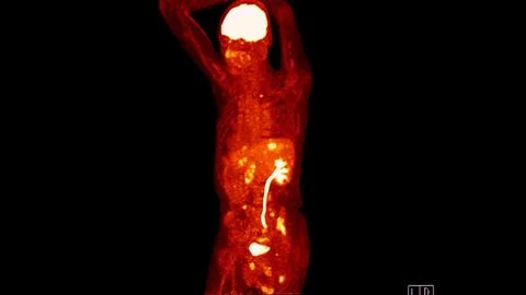 A PET-CT scan image is a diagnostic visualization combining Positron Emissi.. Stock Illustration
