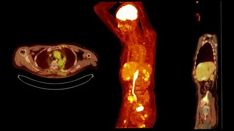 A PET-CT scan image is a diagnostic visualization combining Positron Emissi.. Stock Illustration