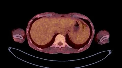 A PET-CT scan image is a diagnostic visualization combining Positron Emissi.. Illustrazione stock