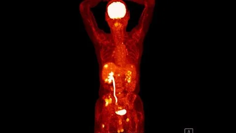 A PET-CT scan image is a diagnostic visualization combining Positron Emissi.. Stock Illustration