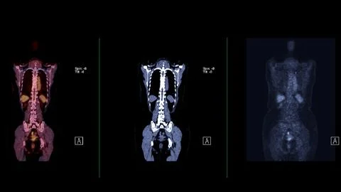 A PET-CT scan image is a diagnostic visualization combining Positron Emissi.. Stock Illustration
