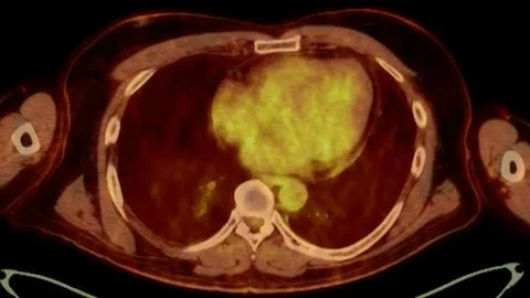 A PET-CT scan image is a diagnostic visualization combining Positron Emissi.. Stock Illustration