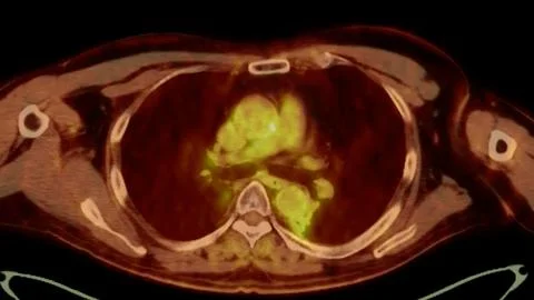A PET-CT scan image is a diagnostic visualization combining Positron Emissi.. Stock Illustration