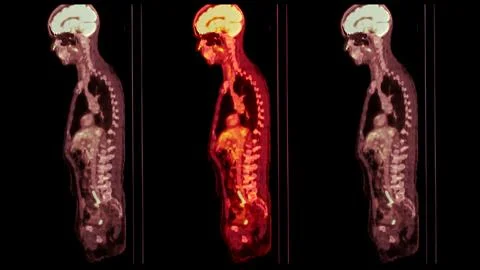 A PET-CT scan image is a diagnostic visualization combining Positron Emissi.. Stock Illustration
