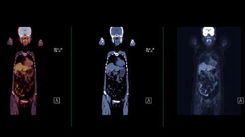 A PET-CT scan image is a diagnostic visualization combining Positron Emissi.. Stock Illustration