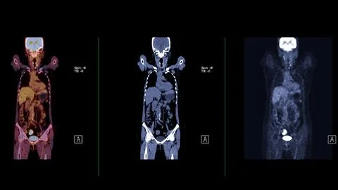 A PET-CT scan image is a diagnostic visualization combining Positron Emissi.. Stock Illustration