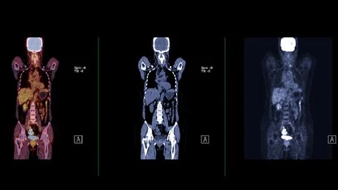 A PET-CT scan image is a diagnostic visualization combining Positron Emissi.. Stock Illustration