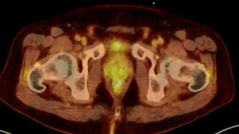 A PET-CT scan image is a diagnostic visualization combining Positron Emissi.. Stock Illustration