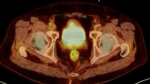 A PET-CT scan image is a diagnostic visualization combining Positron Emissi.. Stock Illustration