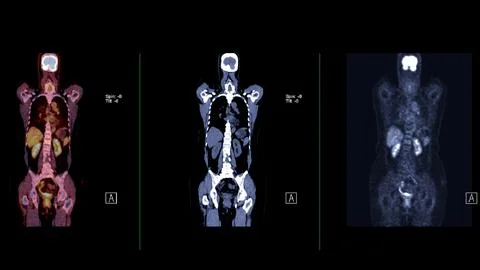 A PET-CT scan image is a diagnostic visualization combining Positron Emissi.. Stock Illustration