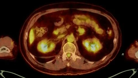 A PET-CT scan image is a diagnostic visualization combining Positron Emissi.. Stock Illustration