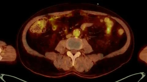 A PET-CT scan image is a diagnostic visualization combining Positron Emissi.. Stock Illustration